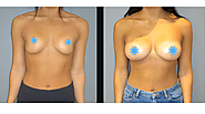 Advantages of breast lift surgery