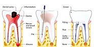 A Tooth Saving Technique | Root Canal Treatment in Noida – Site Title