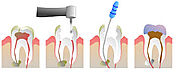 Time Taken for Root Canal Treatment in Noida - freeprachar.com