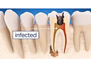 Root Canal Treatment in Mayur Vihar | CDC - Classified Ad