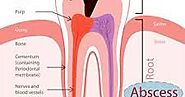 Is there is any need for Root Canal Treatment | Dentist in Noida