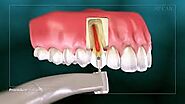 Root canal Treatment in Noida | city dental centre