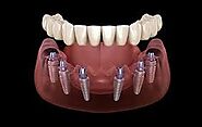 Advantage of Dental Implants in India | CDC – Site Title