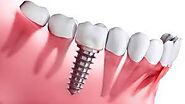 Dental Implant in India at City Dental Centre - Dubai, UAE - Free Classifieds - Muamat