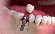 Long Lasting Dental Implants in India - freeprachar.com