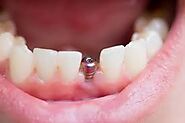 City Dental Centre | Dental Implants in India - freeprachar.com
