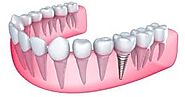 Dental Implant in India at city dental centre