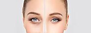 Types of Eyelid Surgery and Effective Cost | HugeCount