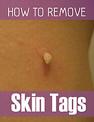 Skin Tag: Causes Of Skin Tags And Treatment - Health Vital Tips