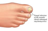 Fungal Infection Treatment | Fungal Nail Treatment