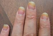 Fungal Infection Treatment | Fungal Nail Treatment: Remove The Impurities And Stay Free From Fungal Infection