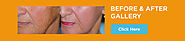 Wrinkles Treatment on Forehead, Under Eye & Lips | Best Deep Wrinkle Treatment in New Jersey (NJ)