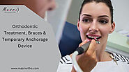 All You Should Know about Orthodontic Treatment, Braces & Temporary Anchorage Device - JustPaste.it