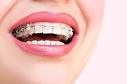 Know Why Lingual Braces Are Best to Restore Your Beautiful Smile | Masri Orthodontics