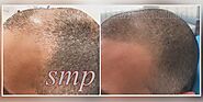 Scalp MicroPigmentation in Dubai - Hair Tattoo | Euromed® Clinic