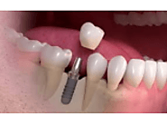 Risk for Dental Implant in India - Classified Ad