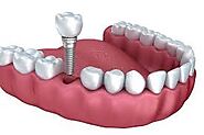 Dental Implant in India, france