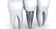 Dental Implant Cost in India | CDC