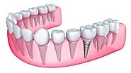 Precaution before Dental Implants in India